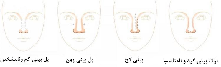 لیفت بینی با نخ برای اصلاح چه مشکلاتی کاربرد دارد؟