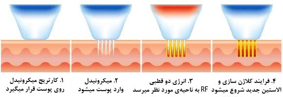تکنیک های مختلف آر اف فرکشنال