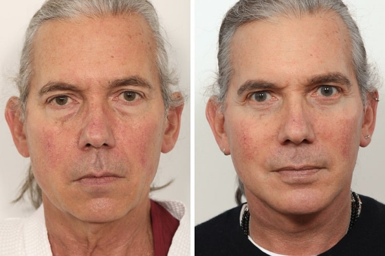 مزایای لیفت صورت بدون جراحی در مردان