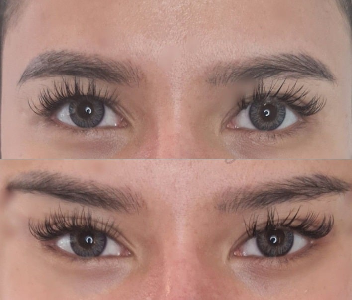 مزایای عمل چشم روباهی